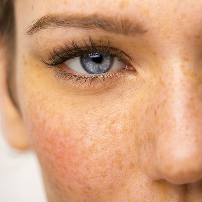 Skin Pigmentation Treatment in Riyadh 2 Dermal Pigmentation Treatment in Riyadh
