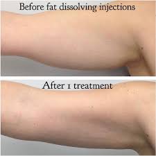 Aqualyx Injections 3 aqualyx injections before and after