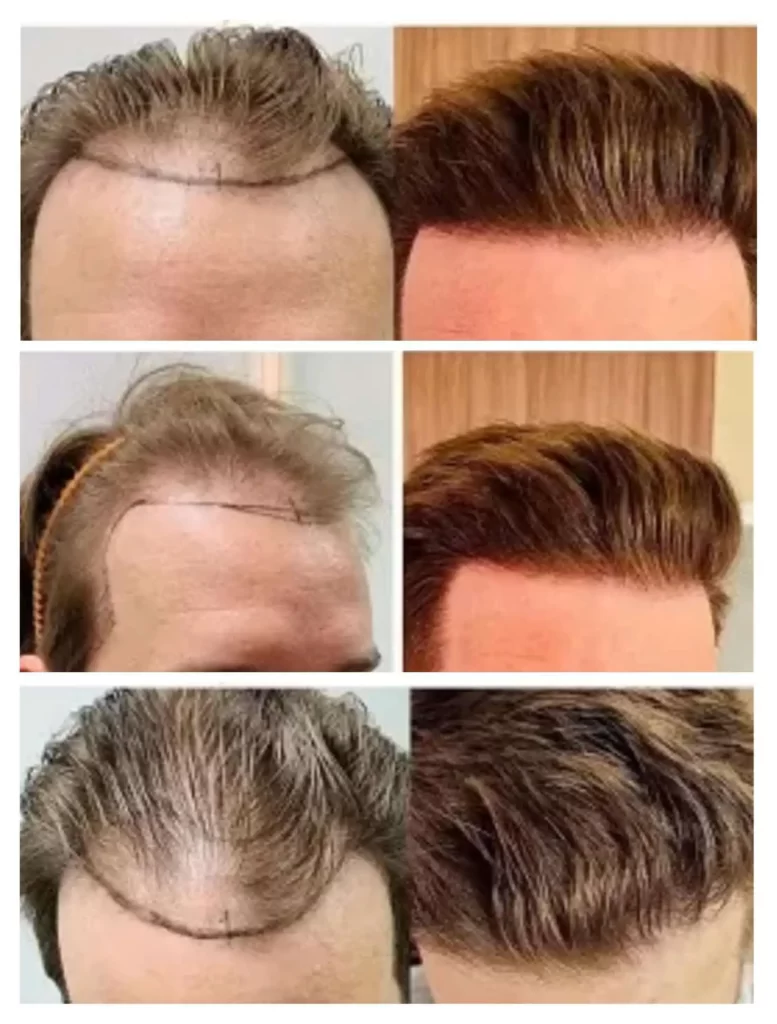 Hair Transplant in Riyadh, Saudi Arabia Cost & Techniques