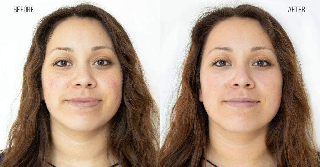 Best HydraFacial in Riyadh | Saudi Arabia 3 hydrafacial treatment results before and after