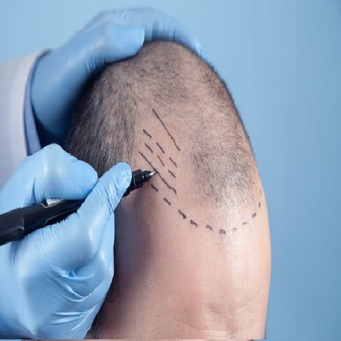 Hair Transplant in Riyadh Saudi Arabia (Riyadh, Jeddah, etc.)