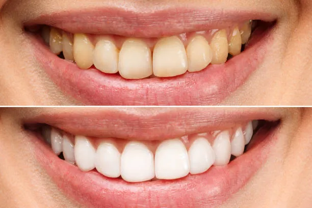 Teeth Whitening 1 woman before and after teeth whitening in riyadh