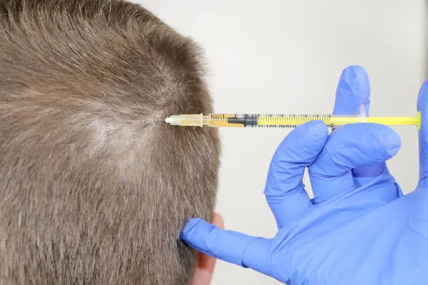 how much is 4000 hair grafts in Riyadh?
