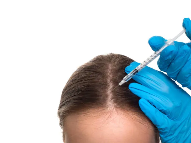 5000 grafts hair transplant in riyadh