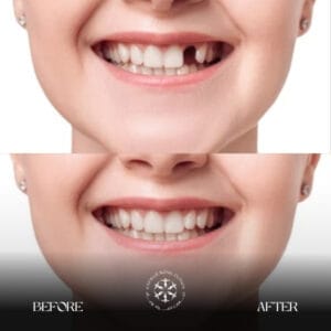 Dental Implants Results