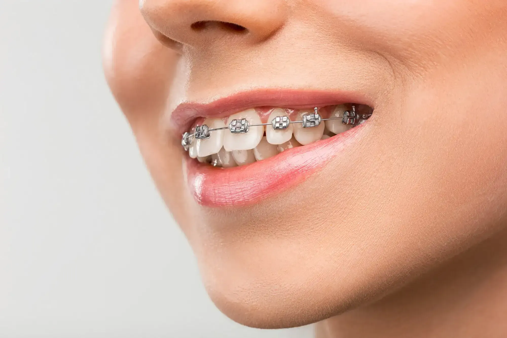 Dental Braces cost in Riyadh, Saudi Arabia