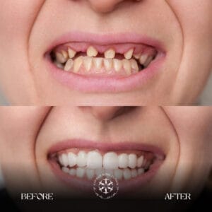 dental implants before after resulsts
