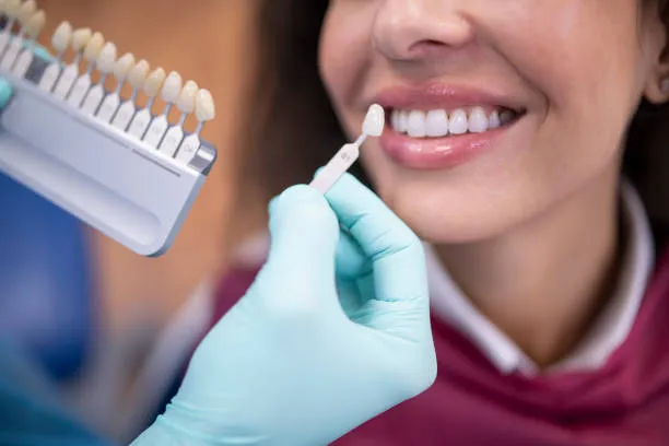 Porcelain Veneers in Riyadh 3 porcelain veneers cost in riyadh