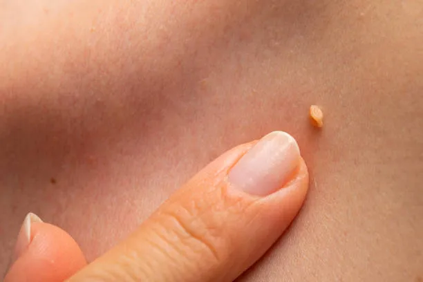 Lipoma Treatment in Riyadh 3 Skin Wart Removal Cost in Riyadh