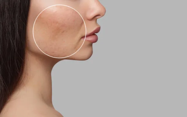Laser Acne Scar Treatment Cost in Riyadh