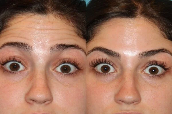 Botox Before & After Results Enfield Royal Clinic Saudi