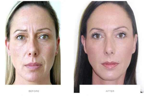 Botox Injection Before & After Results Enfield Royal Clinic Saudi