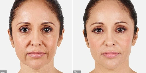 Juvederm Fillers Before After