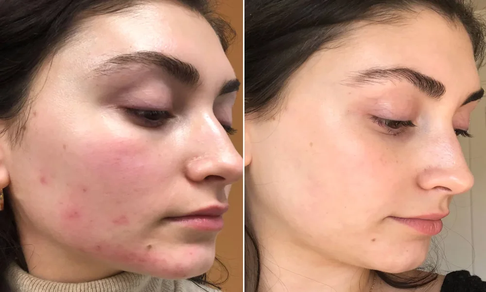 Laser Acne Scar Treatments Before & After Result Enfield Royal Clinic Saudi