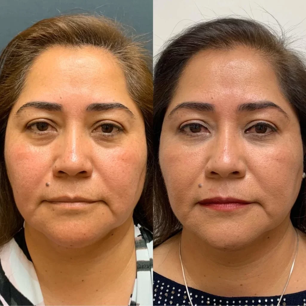 PRP for Face in Riyadh before and after