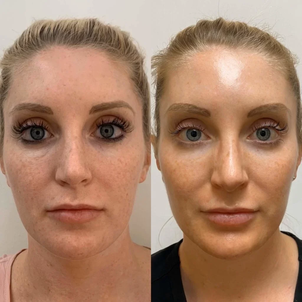 PRP for Face in Riyadh results before and after