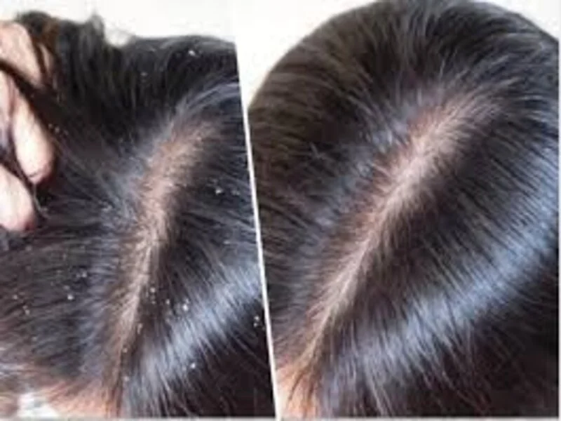 Severe Dandruff Treatment in Riyadh, Jeddah, Saudi ArabiaERC