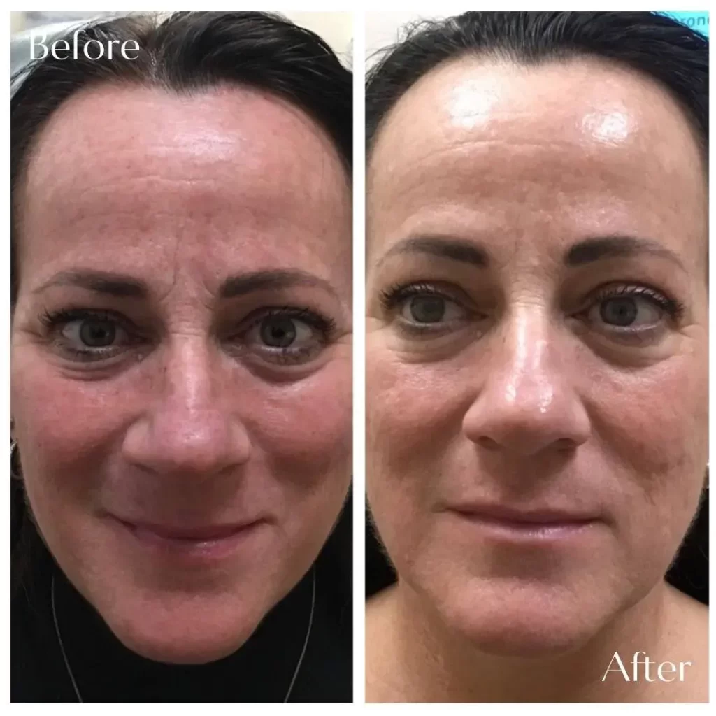 Sylfirm Treatment in Riyadh