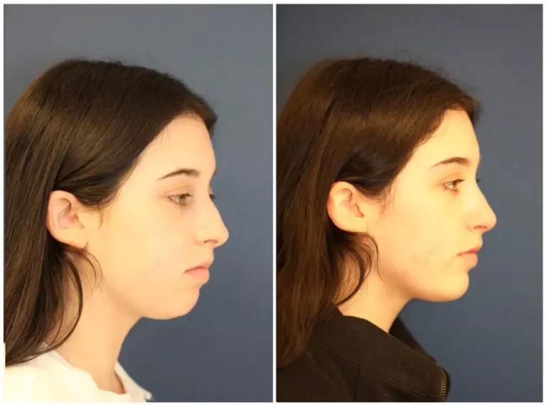 Chin Augmentation in Riyadh | Saudi Arabia 1 chin augmentation before after results in riyadh