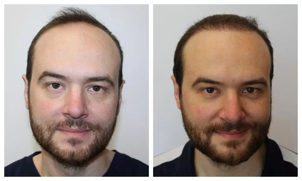 fut hair transplant before after in riyadh