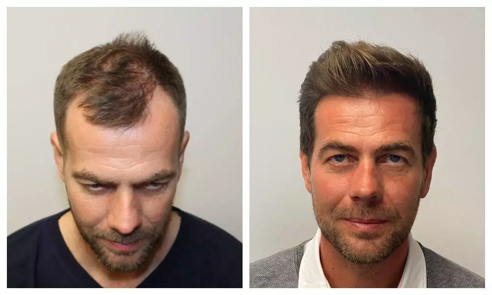 fut hair transplant before after results in riyadh