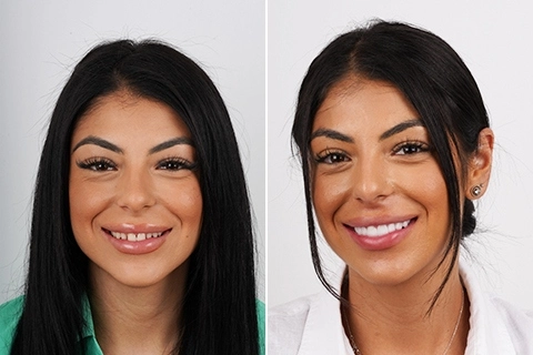 Hollywood Smile Makeover in Riyadh 1 Hollywood Smile Makeover in Riyadh Before After