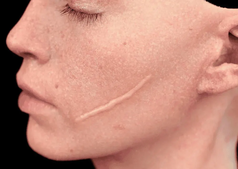 Surgical Revision of Scars in Riyadh 4 Surgical Scar Revision Cost in Riyadh