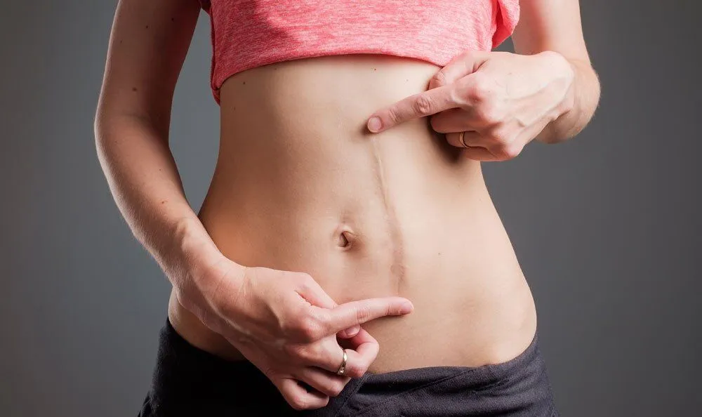 Surgical Revision of Scars in Riyadh 1 scar tissue