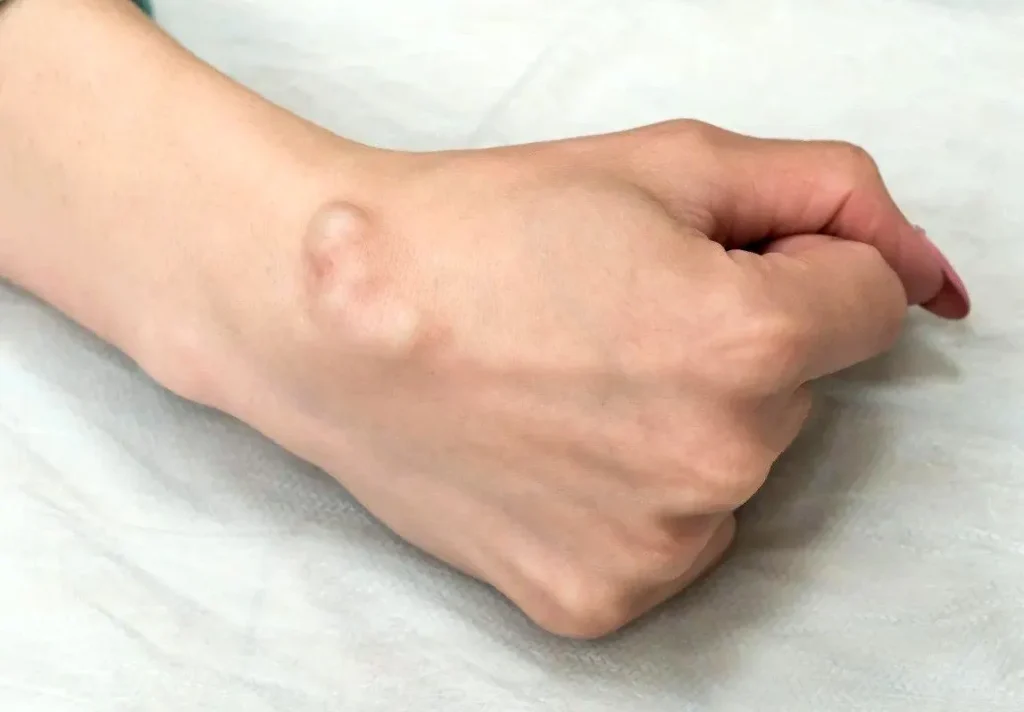 Lipoma Treatment in Riyadh 1 Ideal cnadidate for Lipoma