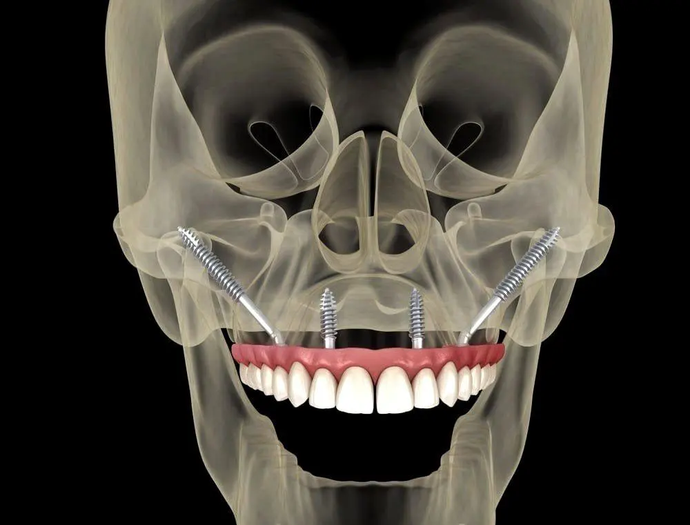 Zygomatic Implants in Riyadh 1 Zygomatic implant procedure