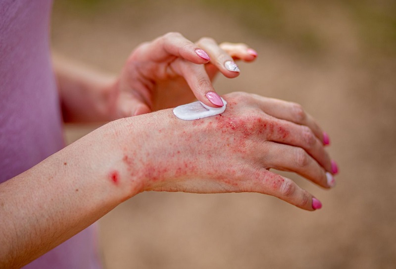 Eczema Treatment in Riyadh 4 Eczema Treatment cost in riyadh