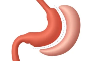 How Much Mini Gastric Bypass Surgery costs in Riyadh