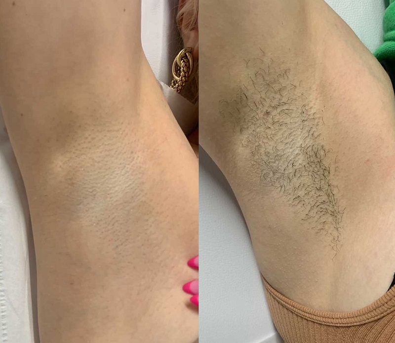 Laser Hair Removal Before After