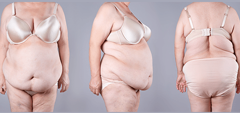 Body Lift Belt Lipectomy in Riyadh 1 Body Lift Belt lLipectomy Results