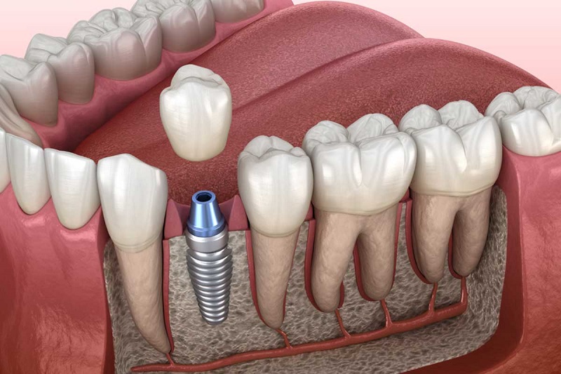 My experience with Dental Implants in Riyadh