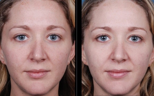 Radiance Peel in Riyadh 1 Radiance Peel Before After Results