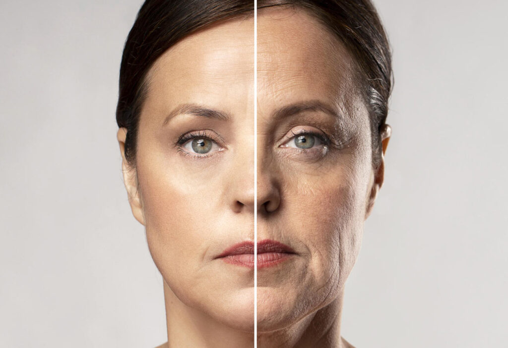 Anti-Aging Treatment in Riyadh, Saudi Arabia 2 anti aging before after results