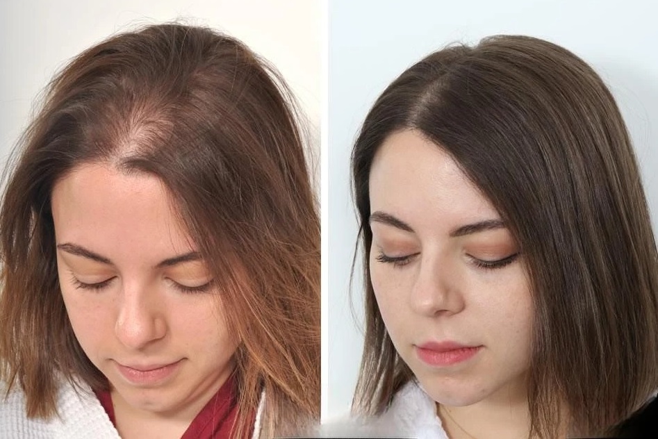 Female Hair Transplant in Riyadh 1 female hair trasnplant before after at enfield royal clinic