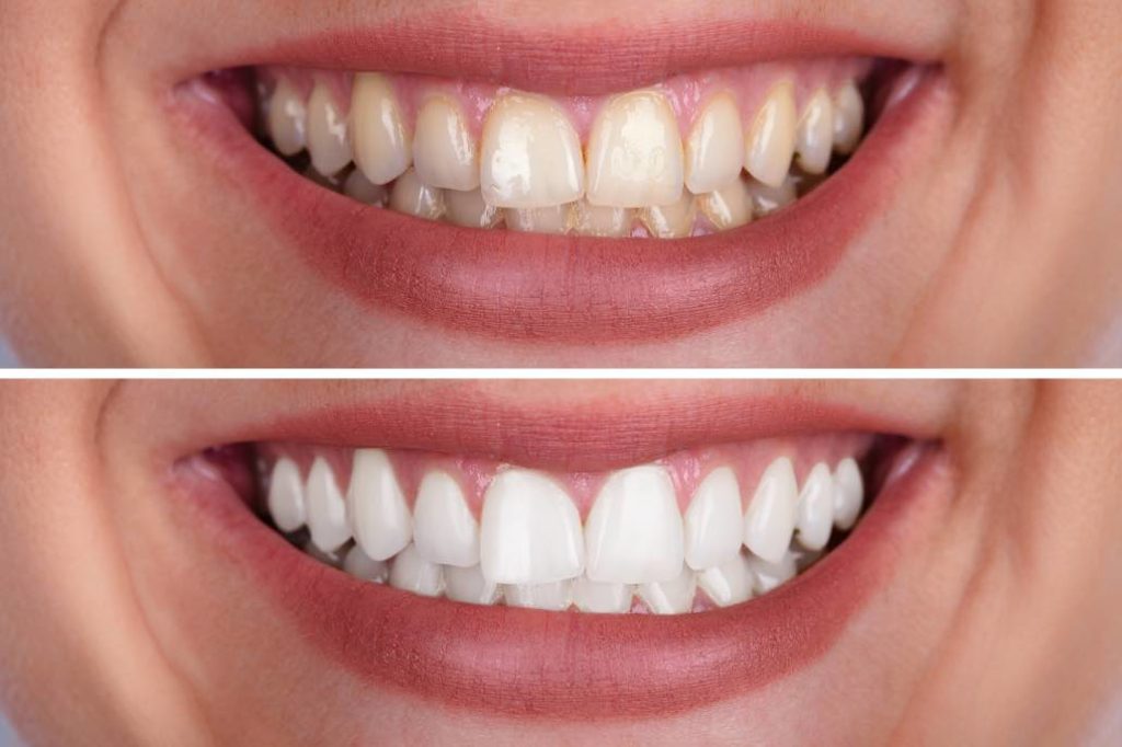 Teeth Whitening in Riyadh 2 teeth whitening before after results