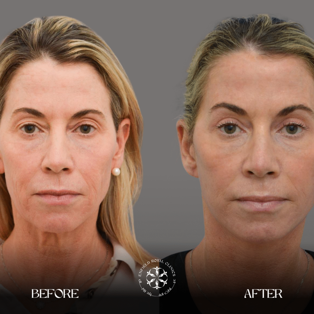 Eyelid Surgery in Riyadh 4 eyelid surgery results in riyadh