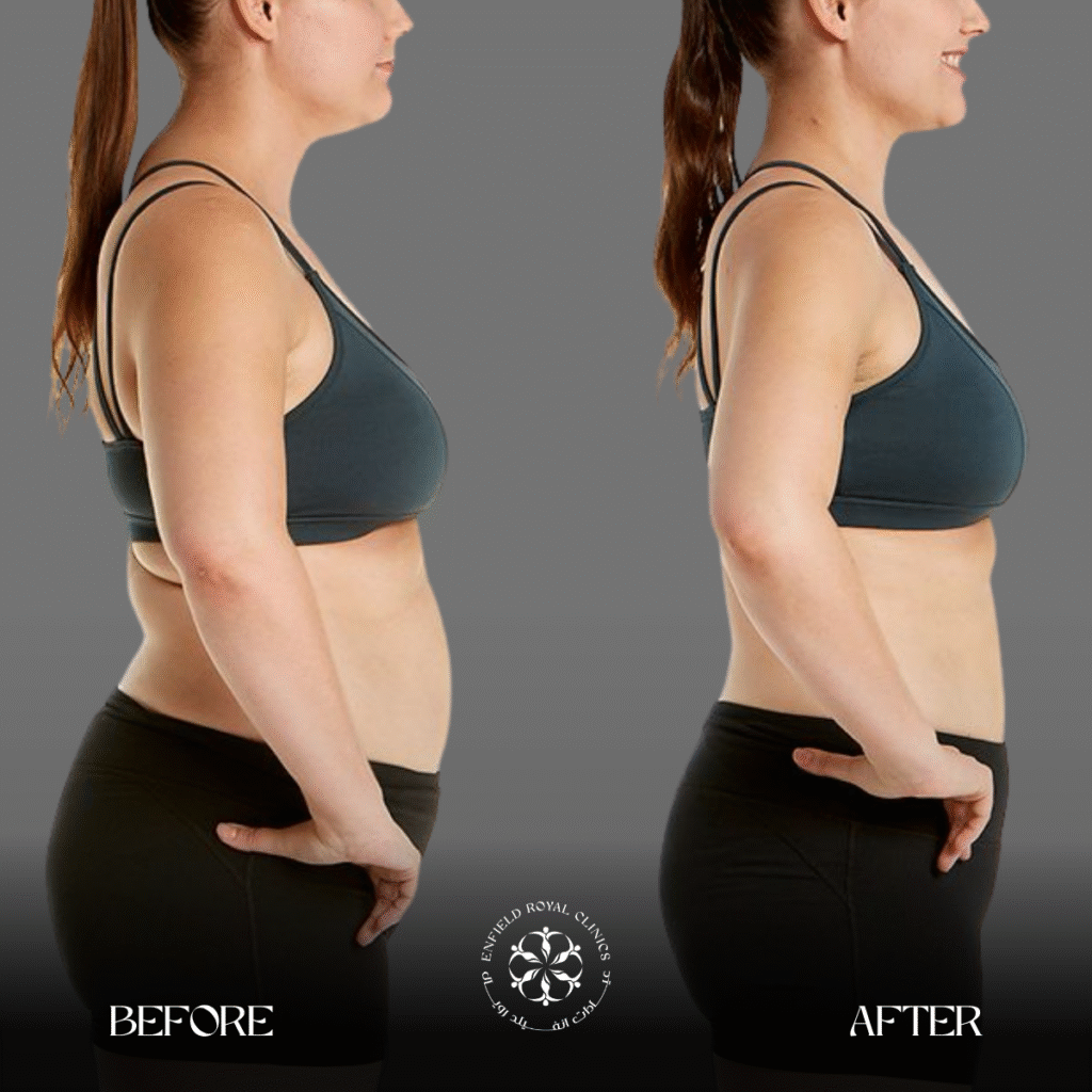 Liposuction in Riyadh 4 Liposuction Before After Resdults