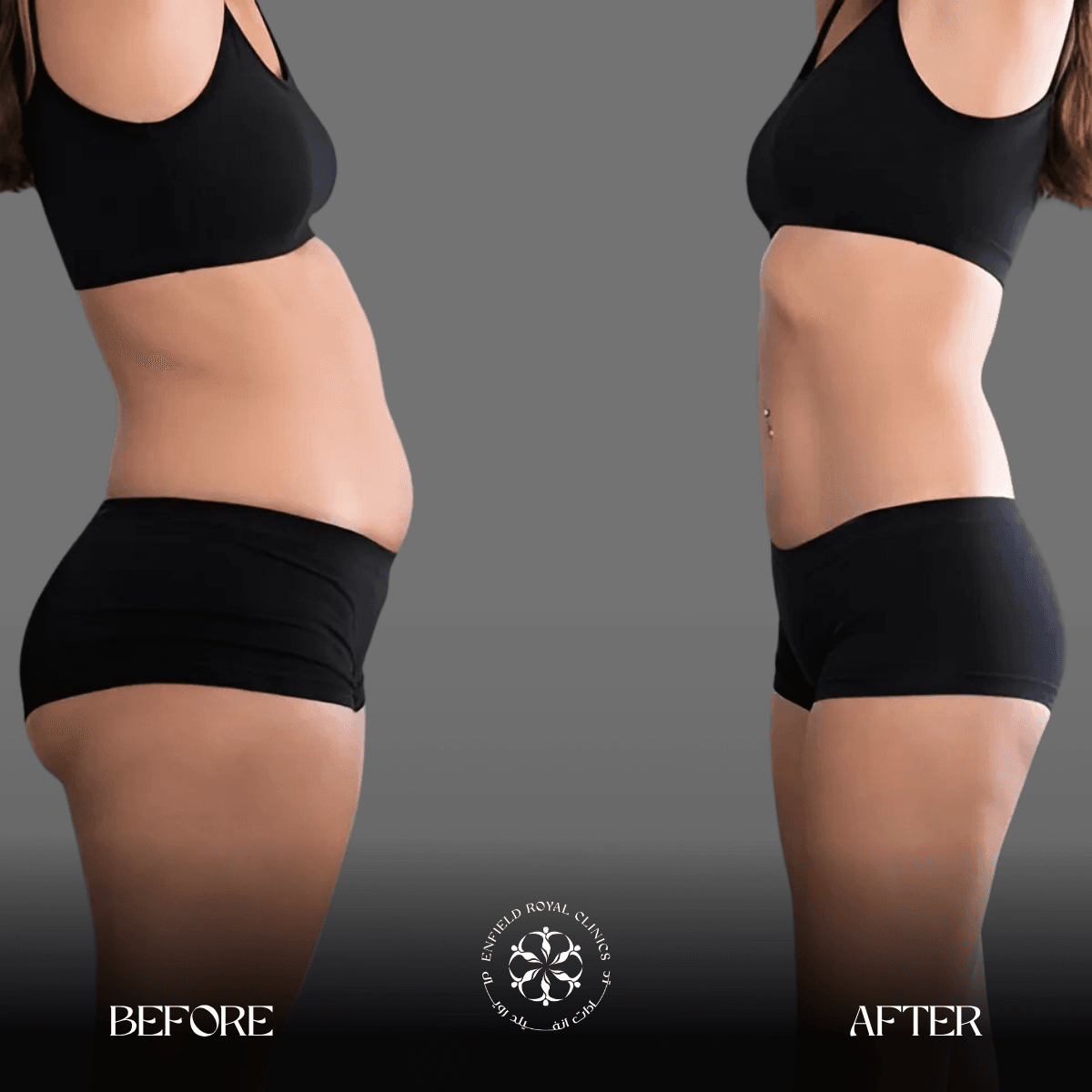 Cosmetic Surgery in Riyadh | Enfield Royal Saudia 11 Liposuction Before After