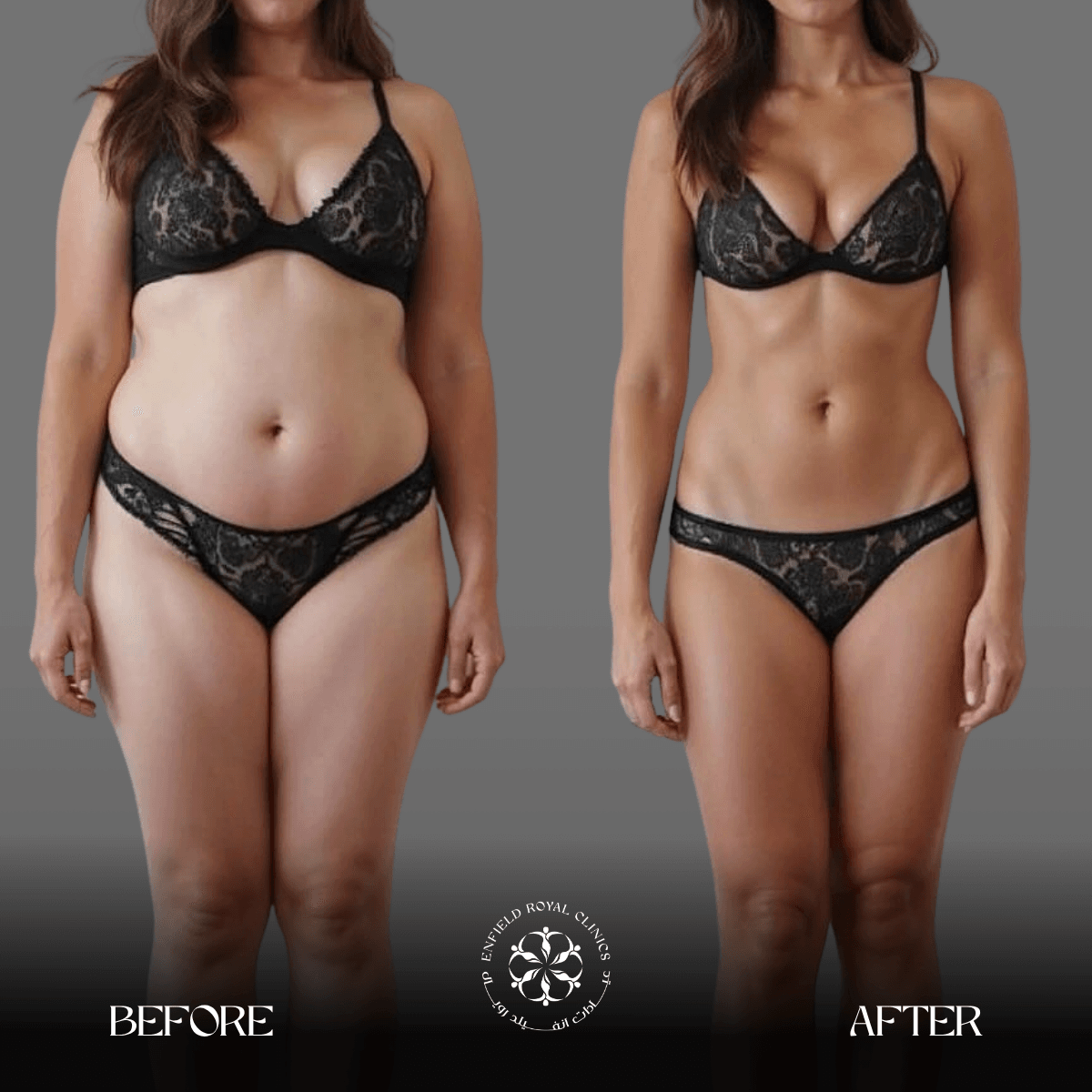 Cosmetic Surgery in Riyadh | Enfield Royal Saudia 10 liposuction lower abdomen before and after
