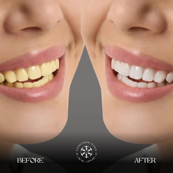 Teeth Whitening in Riyadh 3 TEETH WHITENINg before after ERC