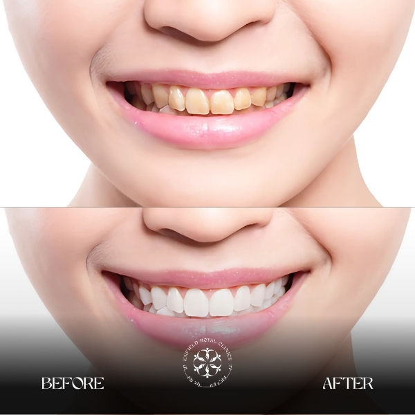 Teeth Whitening in Riyadh 2 Teeth Whitening Results at ERC