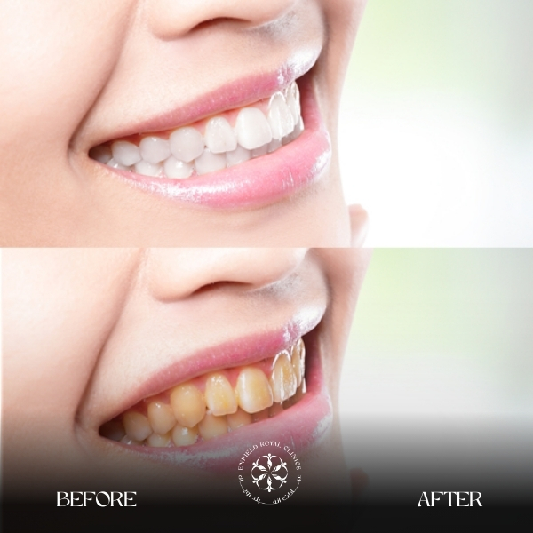 Teeth Whitening in Riyadh 1 Teeth whitening Results at Enfield Royal