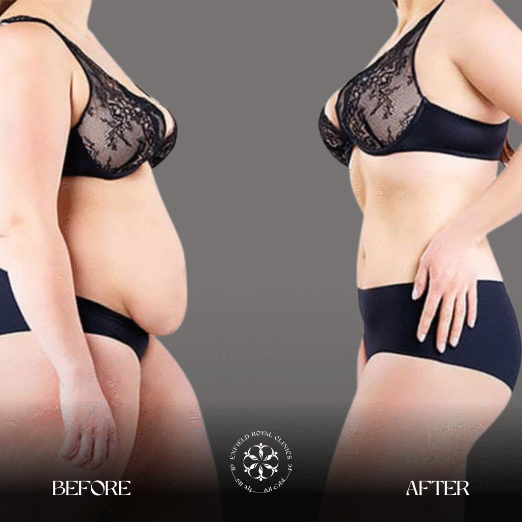 Tummy Tuck in Riyadh 1 Tummy Tuck Before After