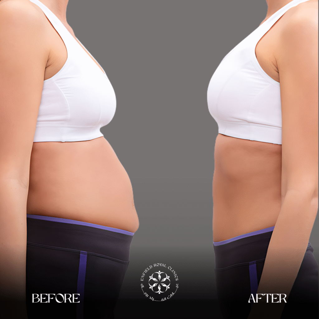 Tummy Tuck in Riyadh 2 Tummy Tuck Resulsts