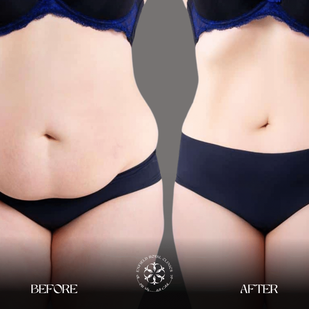 Tummy Tuck in Riyadh 3 Tummy Tuck Surgery Results