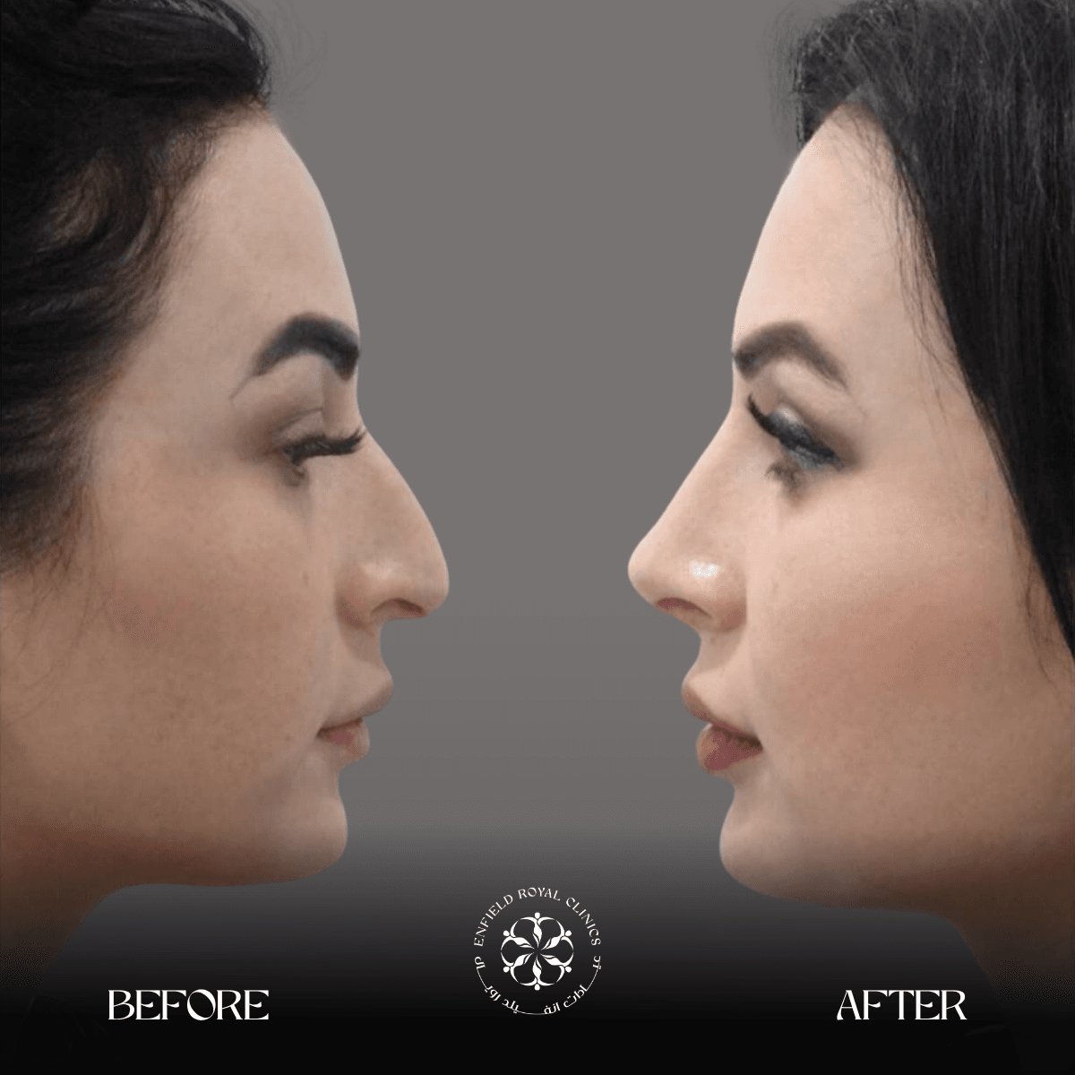 Cosmetic Surgery in Riyadh | Enfield Royal Saudia 9 rhinoplasty in riyadh